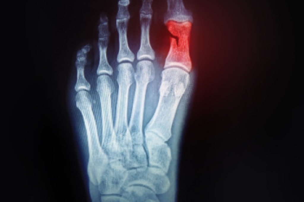 Broken Toe Facts and When to Seek Care