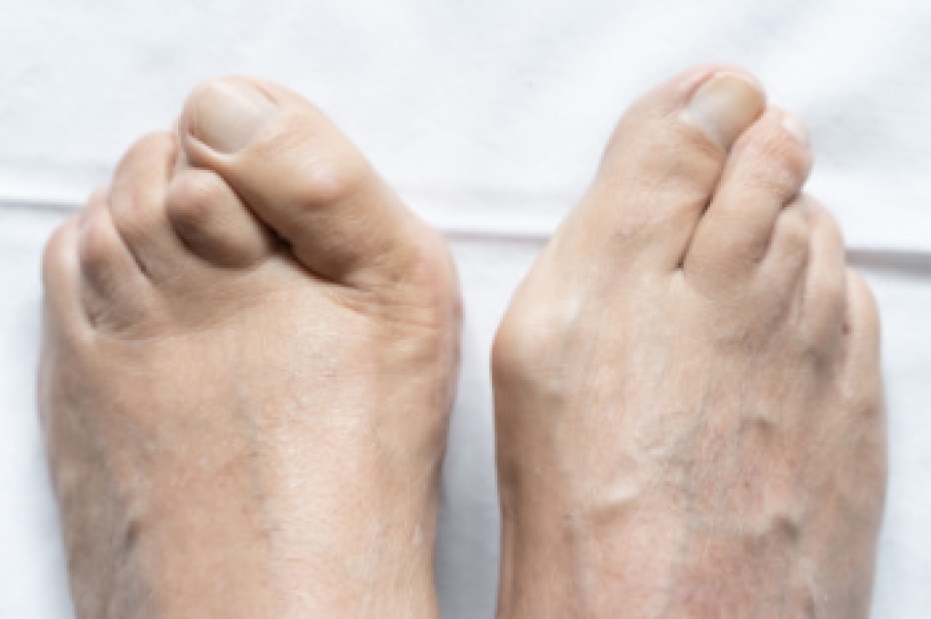 Understanding Bunions From Cause to Care