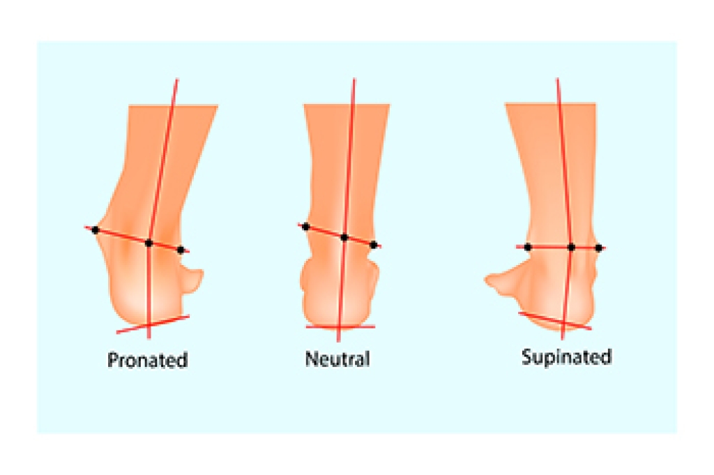 Understanding Pronation Problems in Runners