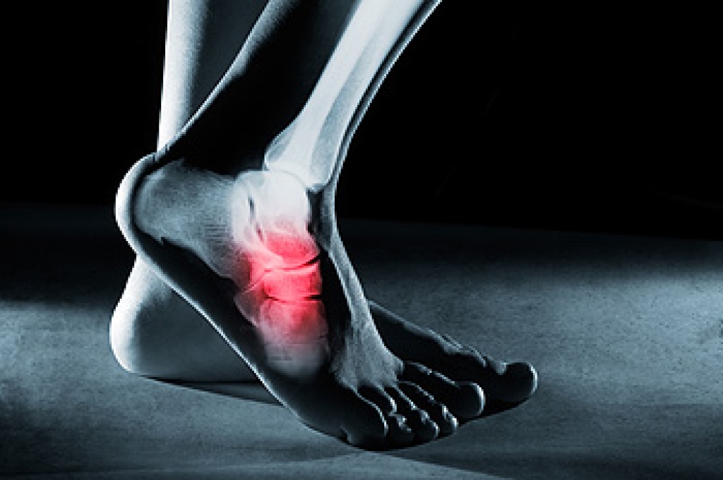 Foot Stress Fractures From Repetitive Impact and Overuse