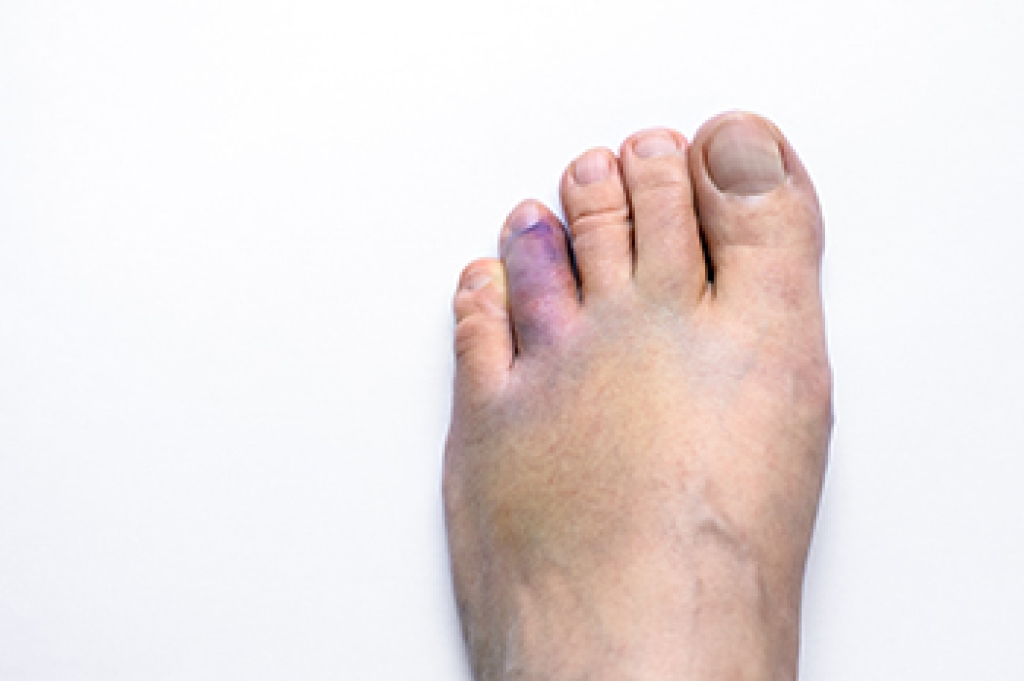 Broken Toe Symptoms and Treatment Options