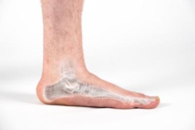 Symptoms and Diagnosis of Flat Feet