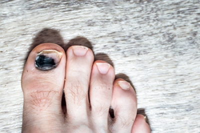 Causes and Treatment of Tennis Toe