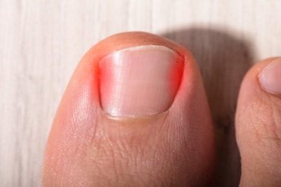The Three Stages of Ingrown Toenails