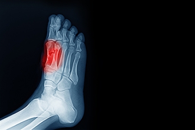 Pain in the Ball of the Foot May Be Sesamoiditis