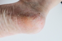 Cracked Heels Relief