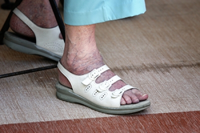 Causes and Implications of Purple Feet