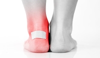 Why a Blister May Develop