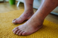 Understanding How Diabetes Affects the Feet