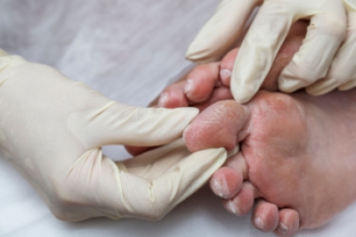 Limb Salvage in Diabetic Foot Care and Making the Decision