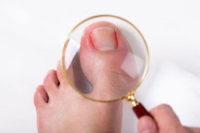 Ingrown Toenail Management