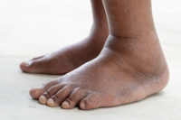 Swollen Feet and When to Seek Care